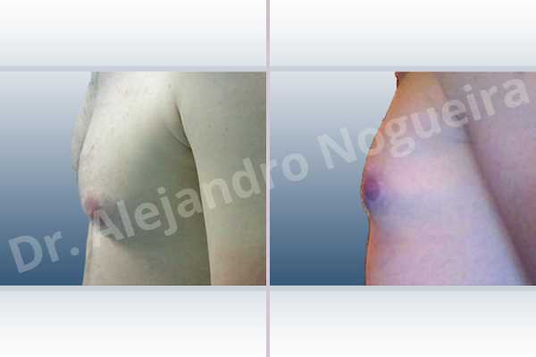 Gynecomastia,Subcutaneous mastectomy,Transareolar incision - photo 2