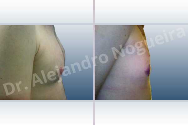 Gynecomastia,Subcutaneous mastectomy,Transareolar incision - photo 4
