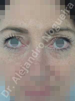 Baggy upper eyelids,Saggy upper eyelids,Upper eyelid fat bags resection,Upper eyelid skin and muscle resection