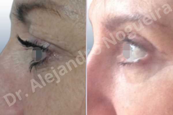 Baggy upper eyelids,Saggy upper eyelids,Upper eyelid fat bags resection,Upper eyelid skin and muscle resection - photo 2