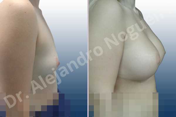 Asymmetric breasts,Empty breasts,Small breasts,Sunken chest,Wide breasts,Inframammary incision,Round shape,Subfascial pocket plane - photo 4