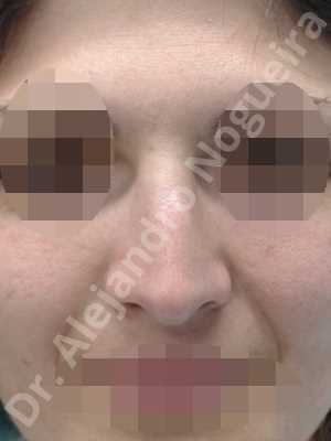 Alar rim retraction,Andine nose,Arabic nose,Asian nose,Asymmetric nose,Asymmetric tip,Bifid tip,Concave lateral cruras,Congenital nose,Crooked nose,Dorsum hump,Dorsum ridges,Hispanic nose,Humpless dorsum,Jewish nose,Low radix,Mixed race blood,Narrow dorsum,Narrow nose,Overrotated tip,Pinched middle vault,Pinched nose,Pointy tip,Poorly supported tip,Rhomboid dorsum,Short nose,Short septum,Short upper lateral cartilages,Small alar cartilages,Small nose,Sunken columella,Sunken supratip,Tension nose,Thin skin nose,Underprojected tip,Columella lengthening,Custom made tip graft,Dorsum hump resection,Dorsum plateau resection,Ear cartilage graft harvesting,Extended shield tip columella graft,Intercrural columella plasty sutures,Interdomal tip plasty sutures,Lateral cruras batten graft,Lateral cruras caudal extension graft,Lateral cruras custom made graft,Lateral cruras lengthening graft,Lateral cruras replacement graft,Lateral cruras repositioning,Medial cruras custom made graft,Nasal bones osteotomies,Onlay columella graft,Onlay supratip graft,Onlay tip graft,Open approach incision,Shield tip graft,Spreader graft,Temporalis fascia graft harvesting,Tip replacement graft,Triangular cartilages caudal extension graft