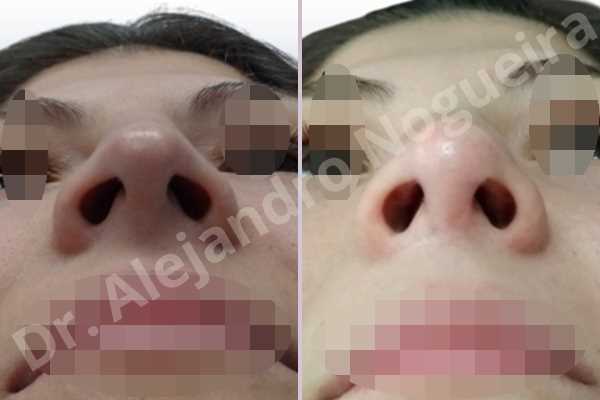 Alar rim retraction,Andine nose,Arabic nose,Asian nose,Asymmetric nose,Asymmetric tip,Bifid tip,Concave lateral cruras,Congenital nose,Crooked nose,Dorsum hump,Dorsum ridges,Hispanic nose,Humpless dorsum,Jewish nose,Low radix,Mixed race blood,Narrow dorsum,Narrow nose,Overrotated tip,Pinched middle vault,Pinched nose,Pointy tip,Poorly supported tip,Rhomboid dorsum,Short nose,Short septum,Short upper lateral cartilages,Small alar cartilages,Small nose,Sunken columella,Sunken supratip,Tension nose,Thin skin nose,Underprojected tip,Columella lengthening,Custom made tip graft,Dorsum hump resection,Dorsum plateau resection,Ear cartilage graft harvesting,Extended shield tip columella graft,Intercrural columella plasty sutures,Interdomal tip plasty sutures,Lateral cruras batten graft,Lateral cruras caudal extension graft,Lateral cruras custom made graft,Lateral cruras lengthening graft,Lateral cruras replacement graft,Lateral cruras repositioning,Medial cruras custom made graft,Nasal bones osteotomies,Onlay columella graft,Onlay supratip graft,Onlay tip graft,Open approach incision,Shield tip graft,Spreader graft,Temporalis fascia graft harvesting,Tip replacement graft,Triangular cartilages caudal extension graft - photo 2