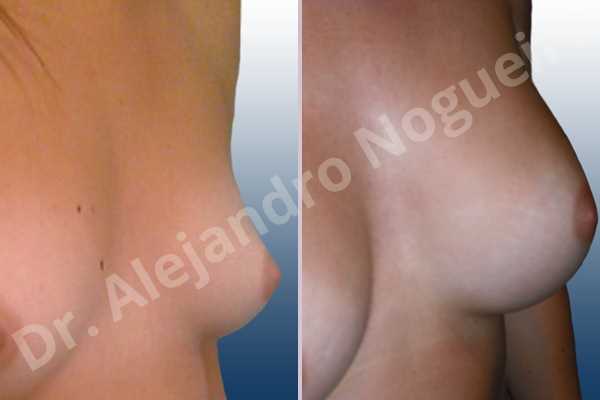 Asymmetric breasts,Narrow breasts,Small breasts,Too far apart wide cleavage breasts,Lateral breasts,Anatomical shape,Inframammary incision,Subfascial pocket plane - photo 3
