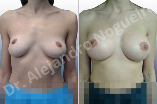 Cross eyed breasts,Empty breasts,Lateral breasts,Mildly saggy droopy breasts,Pendulous breasts,Small breasts,Sunken chest,Too far apart wide cleavage breasts,Wide breasts,Anatomical shape,Lower hemi periareolar incision,Subfascial pocket plane - photo 1