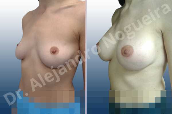 Cross eyed breasts,Empty breasts,Lateral breasts,Mildly saggy droopy breasts,Pendulous breasts,Small breasts,Sunken chest,Too far apart wide cleavage breasts,Wide breasts,Anatomical shape,Lower hemi periareolar incision,Subfascial pocket plane - photo 3