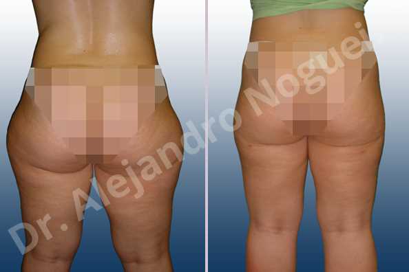 Banana rolls flab,Fatty inner knee,Saddle bags flab,Thigh gap flab,Tumescent liposuction - photo 2