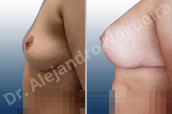 Asymmetric breasts,Breast tissue bottoming out,Cross eyed breasts,Empty breasts,Failed breast reduction,Pendulous breasts,Pigeon chest,Slightly saggy droopy breasts,Small breasts,Wide breasts,Anatomical shape,Anchor incision,Custom incision,Extra large size,Subfascial pocket plane - photo 2
