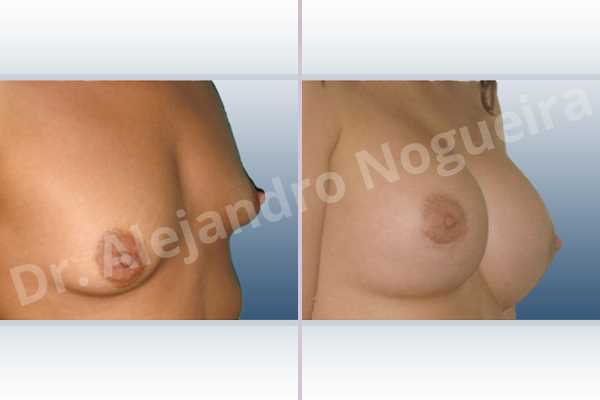 Lateral breasts,Skinny breasts,Small breasts,Too far apart wide cleavage breasts,Tuberous breasts,Extra large size,Lower hemi periareolar incision,Round shape,Subfascial pocket plane,Tuberous mammoplasty - photo 3