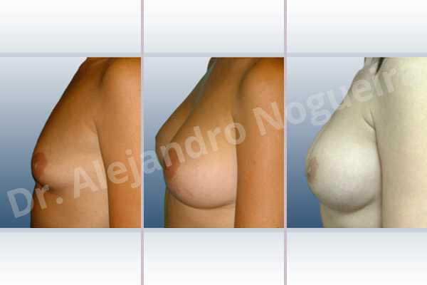 Empty breasts,Lateral breasts,Small breasts,Too far apart wide cleavage breasts,Dual plane pocket,Lower hemi periareolar incision,Round shape - photo 2