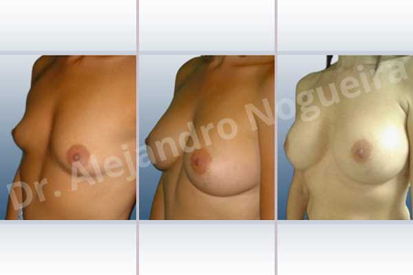 Empty breasts,Lateral breasts,Small breasts,Too far apart wide cleavage breasts,Dual plane pocket,Lower hemi periareolar incision,Round shape - photo 3