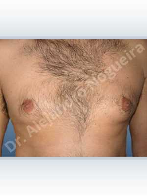 Gynecomastia,Subcutaneous mastectomy,Transareolar incision