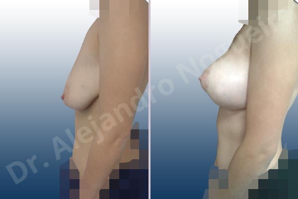 Asymmetric breasts,Empty breasts,Pendulous breasts,Severely saggy droopy breasts,Anatomical shape,Extra large size,Lollipop incision,Subfascial pocket plane,Superior pedicle - photo 2