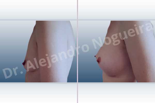 Cross eyed breasts,Empty breasts,Lateral breasts,Skinny breasts,Slightly saggy droopy breasts,Small breasts,Too far apart wide cleavage breasts,Wide breasts,Anatomical shape,Inframammary incision,Subfascial pocket plane - photo 2