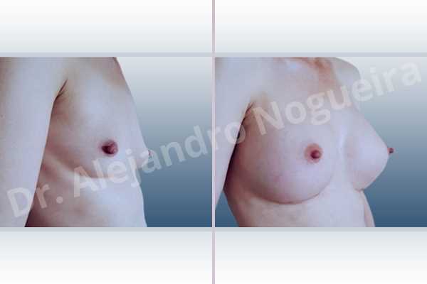 Cross eyed breasts,Empty breasts,Lateral breasts,Skinny breasts,Slightly saggy droopy breasts,Small breasts,Too far apart wide cleavage breasts,Wide breasts,Anatomical shape,Inframammary incision,Subfascial pocket plane - photo 5
