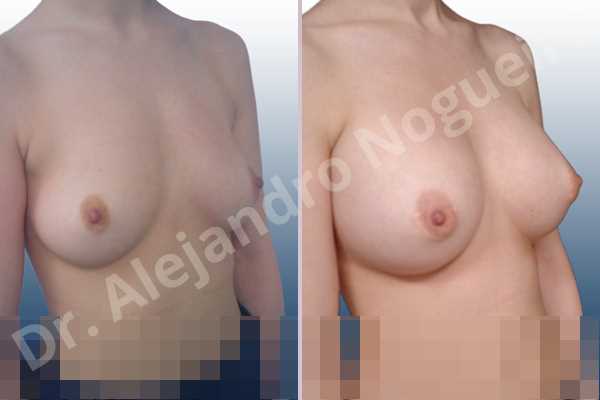 Asymmetric breasts,Empty breasts,Lateral breasts,Pigeon chest,Small breasts,Too far apart wide cleavage breasts,Lower hemi periareolar incision,Round shape,Subfascial pocket plane - photo 5