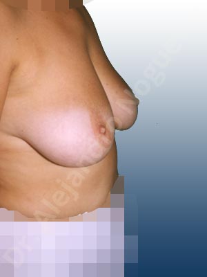 Breast tissue bottoming out,Moderately saggy droopy breasts,Pendulous breasts,Lollipop incision,Superior pedicle