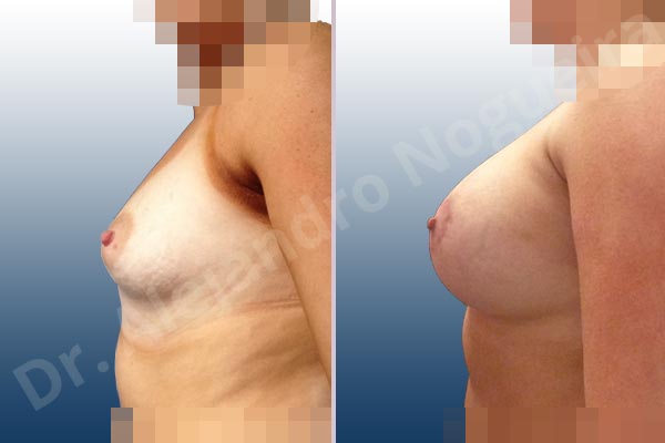Asymmetric breasts,Empty breasts,Large areolas,Lateral breasts,Mildly saggy droopy breasts,Narrow breasts,Skinny breasts,Slightly saggy droopy breasts,Small breasts,Sunken scars,Too far apart wide cleavage breasts,Tuberous breasts,Anatomical shape,Areola reduction,Circumareolar incision,Subfascial pocket plane,Tuberous mammoplasty - photo 2