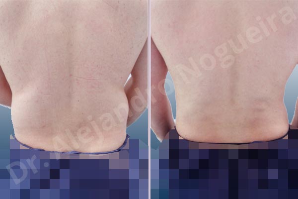 Love handles flab,Tumescent liposuction - photo 1