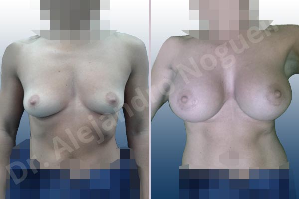 Asymmetric breasts,Empty breasts,Skinny breasts,Slightly saggy droopy breasts,Small breasts,Anatomical shape,Extra large size,Lower hemi periareolar incision,Subfascial pocket plane - photo 1