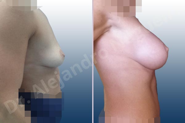 Asymmetric breasts,Empty breasts,Skinny breasts,Slightly saggy droopy breasts,Small breasts,Anatomical shape,Extra large size,Lower hemi periareolar incision,Subfascial pocket plane - photo 4
