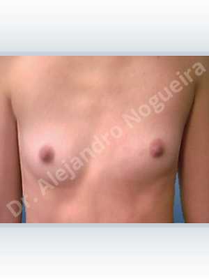 Asymmetric breasts,Skinny breasts,Small breasts,Inframammary incision,Round shape,Subfascial pocket plane