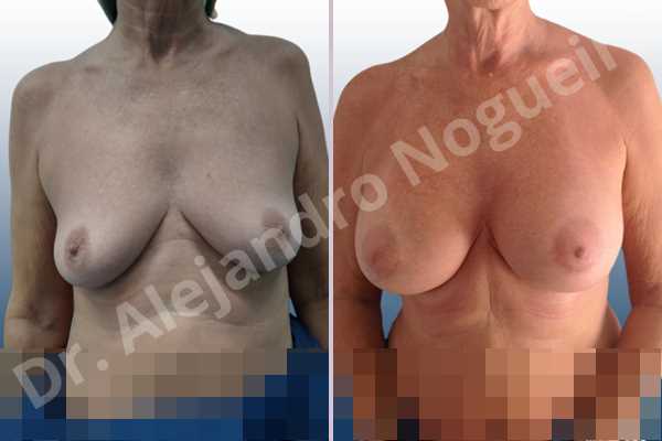 Empty breasts,Lateral breasts,Moderately saggy droopy breasts,Small breasts,Too far apart wide cleavage breasts,Wide breasts,Anatomical shape,Lower hemi periareolar incision,Subfascial pocket plane - photo 1