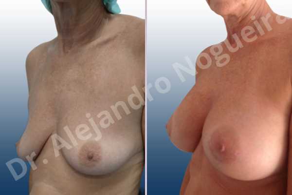 Empty breasts,Lateral breasts,Moderately saggy droopy breasts,Small breasts,Too far apart wide cleavage breasts,Wide breasts,Anatomical shape,Lower hemi periareolar incision,Subfascial pocket plane - photo 3