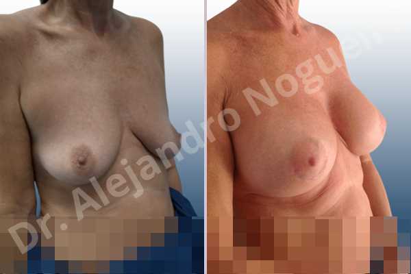Empty breasts,Lateral breasts,Moderately saggy droopy breasts,Small breasts,Too far apart wide cleavage breasts,Wide breasts,Anatomical shape,Lower hemi periareolar incision,Subfascial pocket plane - photo 5