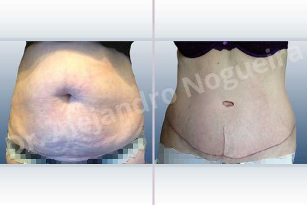 Saggy abdomen,Weak abdomen muscles,Standard abdominoplasty - photo 1
