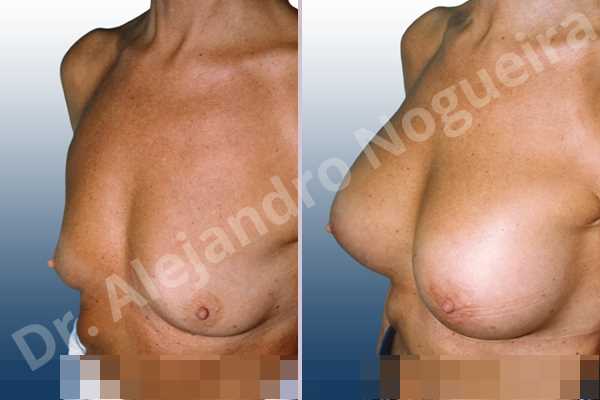 Empty breasts,Lateral breasts,Pigeon chest,Skinny breasts,Slightly saggy droopy breasts,Small breasts,Too far apart wide cleavage breasts,Wide breasts,Anatomical shape,Lower hemi periareolar incision,Subfascial pocket plane - photo 2