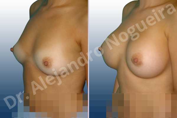 Asymmetric breasts,Cross eyed breasts,Lateral breasts,Pigeon chest,Slightly saggy droopy breasts,Small breasts,Too far apart wide cleavage breasts,Lower hemi periareolar incision,Round shape,Subfascial pocket plane - photo 3