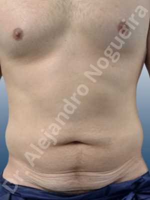 Saggy abdomen,Standard abdominoplasty
