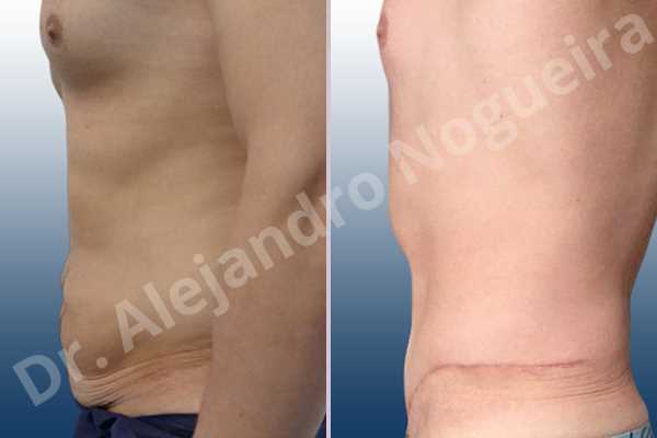 Saggy abdomen,Standard abdominoplasty - photo 2