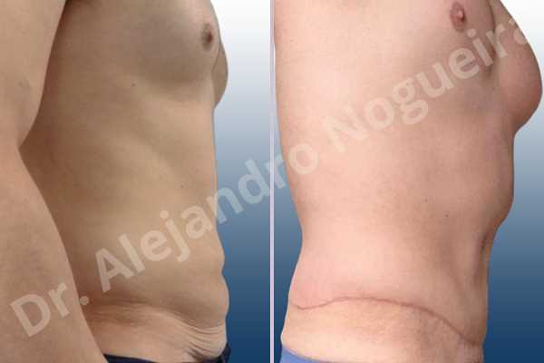 Saggy abdomen,Standard abdominoplasty - photo 4