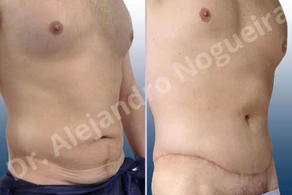 Saggy abdomen,Standard abdominoplasty - photo 5