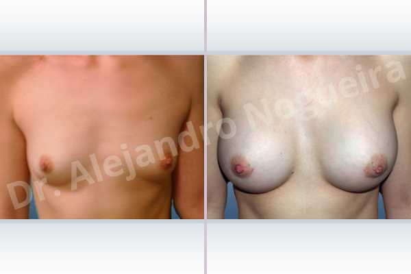 Asymmetric breasts,Lateral breasts,Skinny breasts,Small breasts,Too far apart wide cleavage breasts,Anatomical shape,Lower hemi periareolar incision,Subfascial pocket plane - photo 1