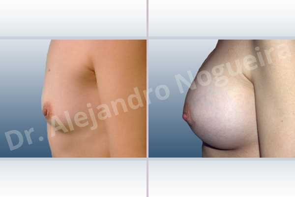 Asymmetric breasts,Lateral breasts,Skinny breasts,Small breasts,Too far apart wide cleavage breasts,Anatomical shape,Lower hemi periareolar incision,Subfascial pocket plane - photo 2