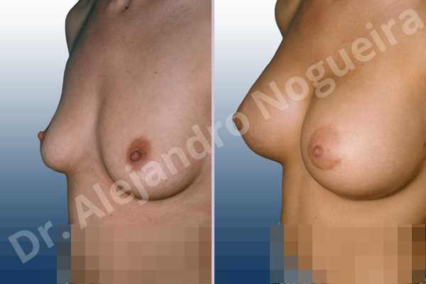 Wide breasts,Empty breasts,Slightly saggy droopy breasts,Small breasts,Anatomical shape,Lower hemi periareolar incision,Subfascial pocket plane - photo 1