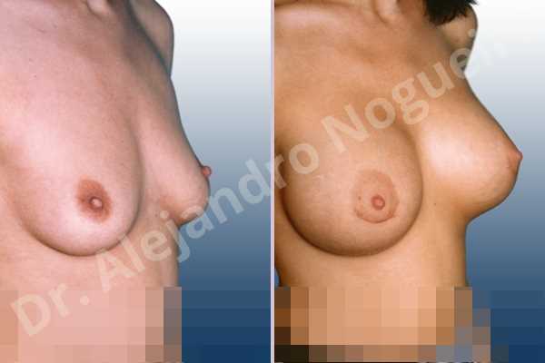 Wide breasts,Empty breasts,Slightly saggy droopy breasts,Small breasts,Anatomical shape,Lower hemi periareolar incision,Subfascial pocket plane - photo 2