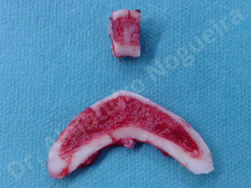 Large chin,Prominent chin,Horizontal osseous chin resection,Oblique chin osteotomy,Osseous chin setback,Three dimensional genioplasty,Vertical osseous chin resection - photo 13