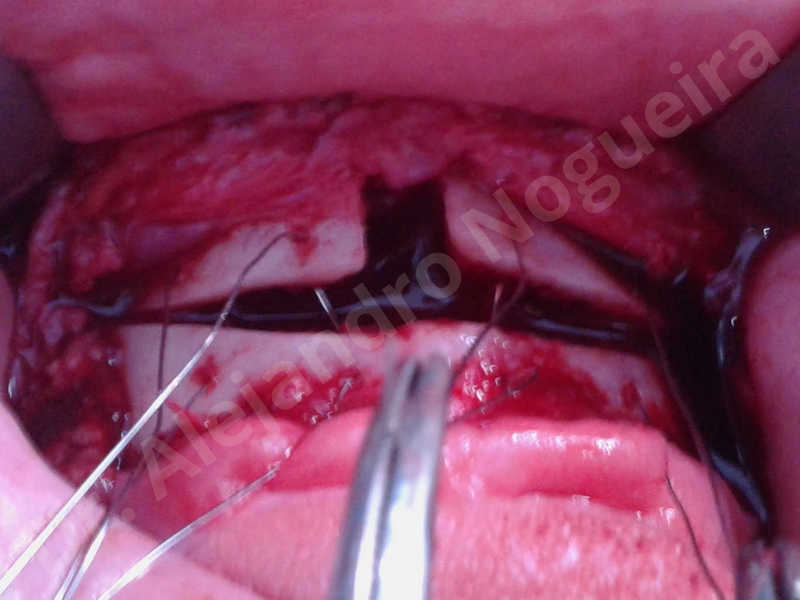 Large chin,Prominent chin,Horizontal osseous chin resection,Oblique chin osteotomy,Osseous chin setback,Three dimensional genioplasty,Vertical osseous chin resection - photo 21