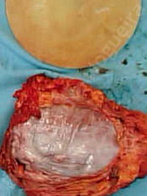Asymmetric breasts,Breast implants animation muscle flex deformity,Breast implants capsular contracture,Breast implants capsule calcification,Breast implants displacement malposition,Breast implants riding too high,Breast implants visibility palpability,Cross eyed breasts implants,Mildly large breasts,Moderately saggy droopy breasts,Severely saggy droopy breasts,Slightly large breasts,Too far apart wide cleavage breasts,Waterfall effect breast implants,Wide breasts,Capsulectomy