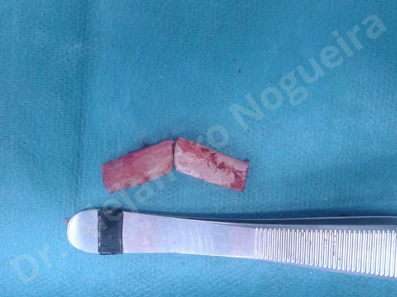 Small chin,Weak chin,Elbow bone graft harvesting,Oblique chin osteotomy,Osseous chin advancement,Two dimensional genioplasty,Vertical osseous chin grafting - photo 5