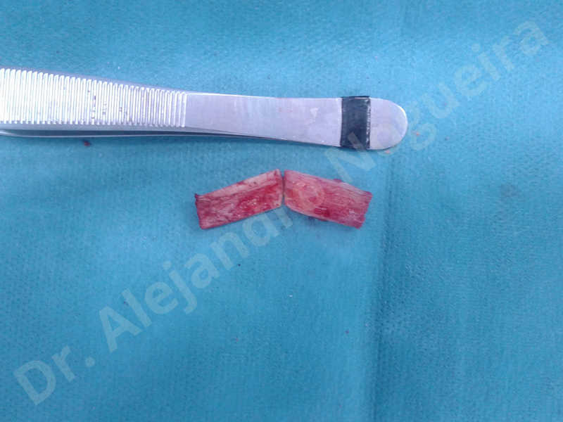 Small chin,Weak chin,Elbow bone graft harvesting,Oblique chin osteotomy,Osseous chin advancement,Two dimensional genioplasty,Vertical osseous chin grafting - photo 7