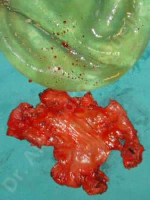 Breast implants capsular contracture,Breast implants capsule calcification,Breast implants displacement malposition,Breast implants extrusion,Breast implants infection,Breast implants riding too high,Breast implants side boob,Breast implants visibility palpability,Breast tissue infection,Breast tissue necrosis,Broken breast implants,Cross eyed breasts implants,Empty breasts,Too far apart wide cleavage breast implants,Too narrow breast implants,Waterfall effect breast implants,Wide breasts,Capsulectomy,Custom incision,Excisional scar revision,Puss evacuation