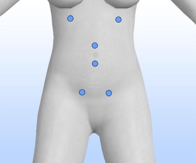 scars abdomen liposuction