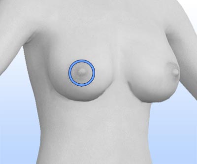 scars tuberous breast correction
