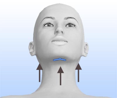 scars face lift and neck lift - II