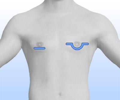 scars gynecomastia reduction - I